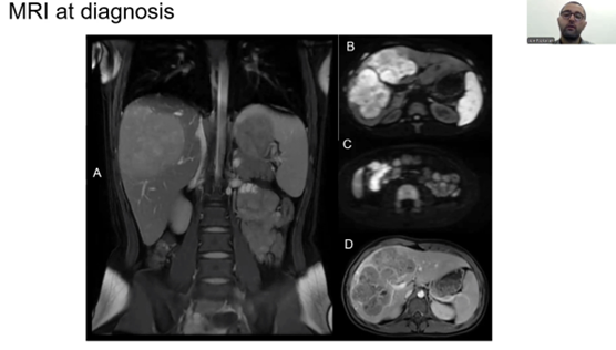 2nd Place: Imaging Features of Hepatic PEComa